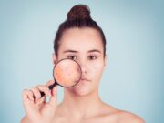 Διατροφή και ακμή – Ο ρόλος της διατροφής στην εμφάνιση ή και μείωση των συμπτωμάτων ακμής Διατροφή και ακμή