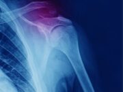 Οστεοπορωτικό κάταγμα: η «μάστιγα» του 21ου αιώνα Οστεοπορωτικό κάταγμα