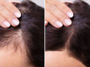 Μεταμόσχευση μαλλιών: τι είναι μύθος και τι όχι Μεταμόσχευση μαλλιών: τι είναι μύθος και τι όχι