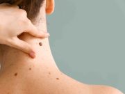 Μελάνωμα: Η σημασία της έγκαιρης διάγνωσης Μελάνωμα