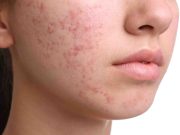 Acne Positivity Day: Η ακμή δεν επηρεάζει μόνο το δέρμα μας ακμή δέρμα
